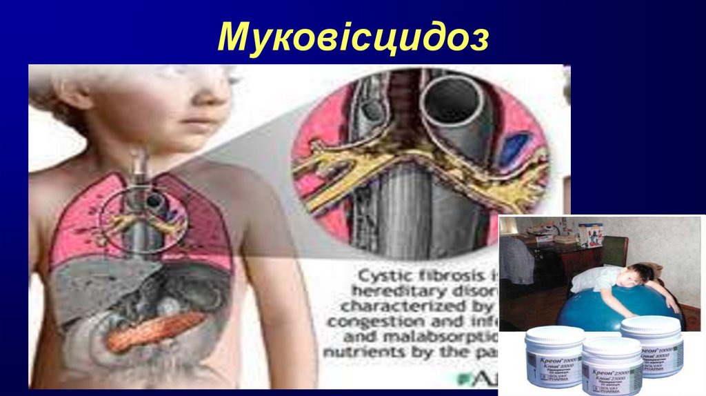 Муковісцидоз