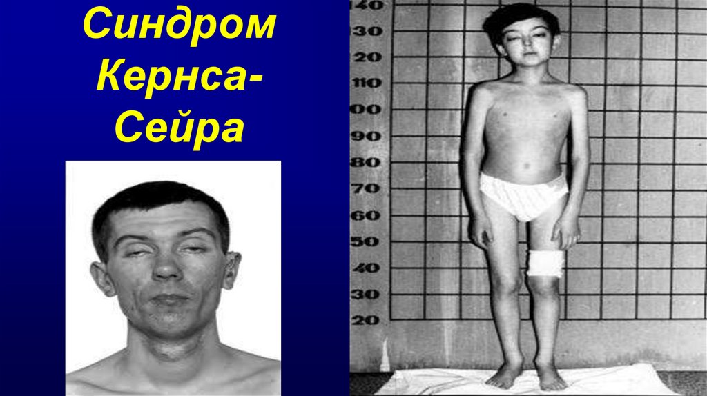 Синдром Кернса-Сейра