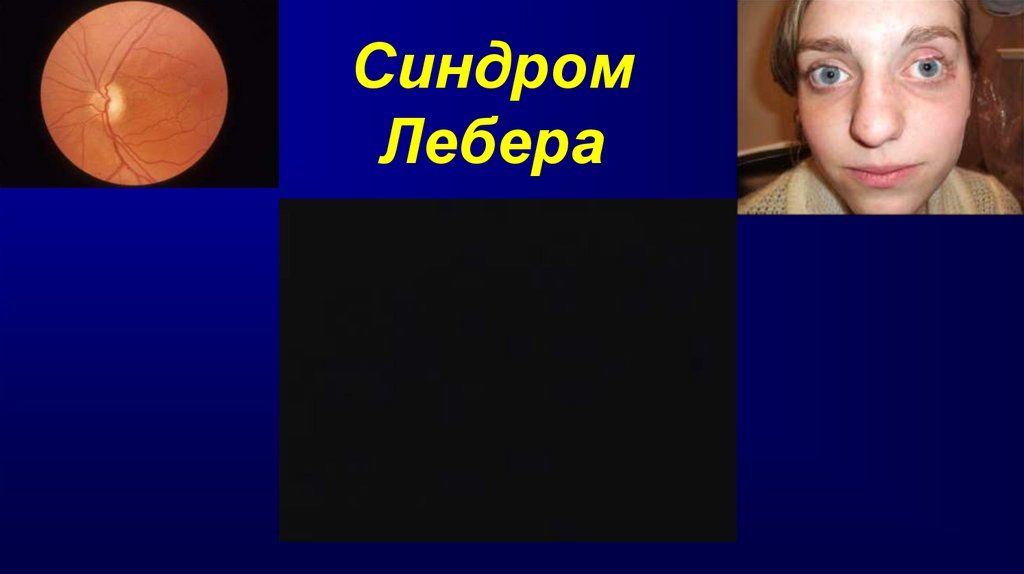 Синдром Лебера