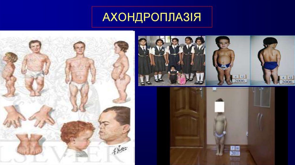 АХОНДРОПЛАЗІЯ