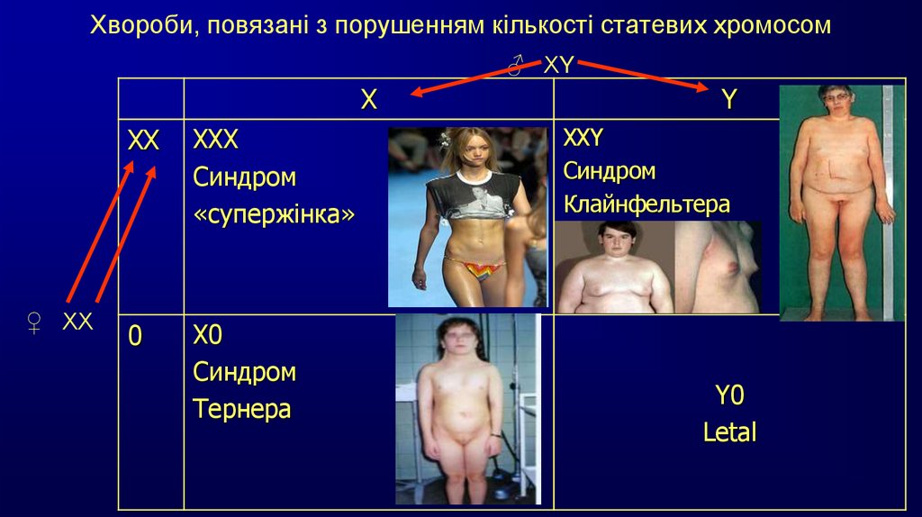 Хвороби, повязані з порушенням кількості статевих хромосом