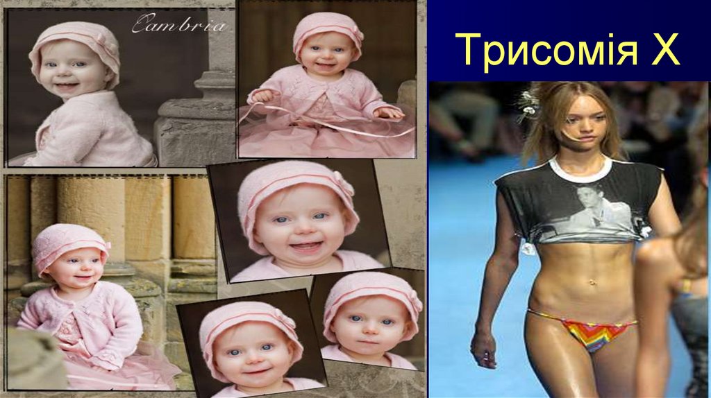 Трисомія Х