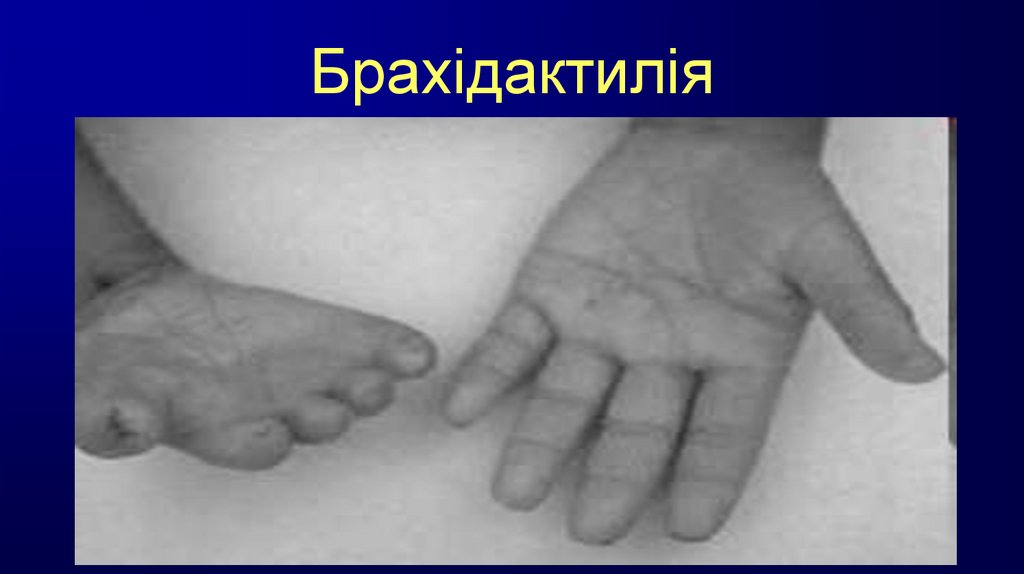 Брахідактилія