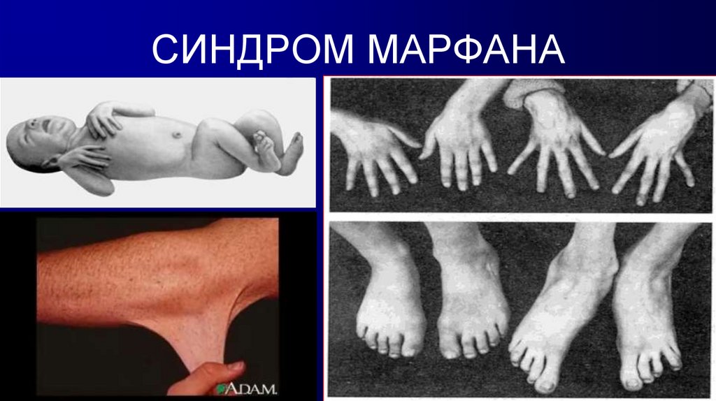 СИНДРОМ МАРФАНА