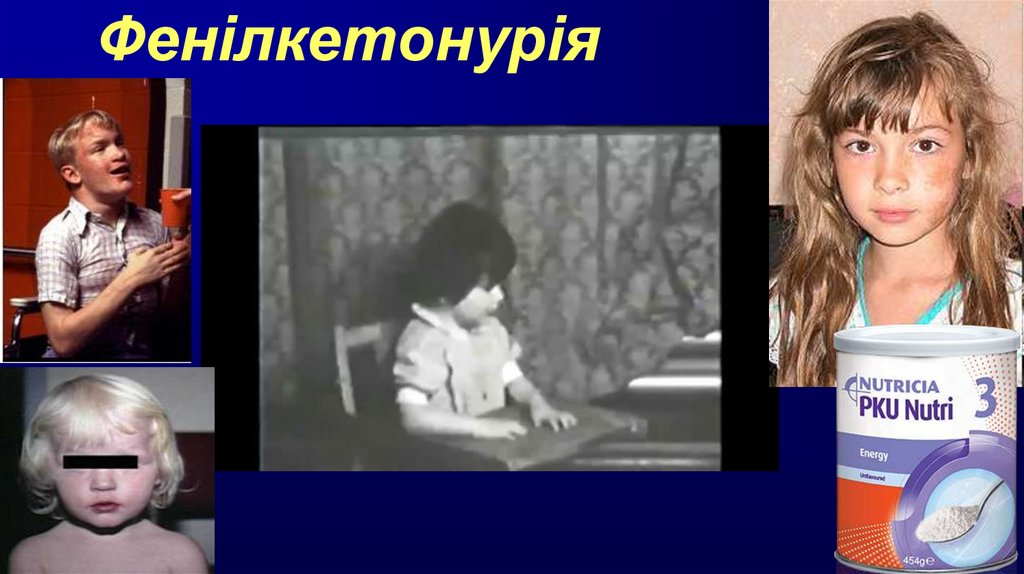 Фенілкетонурія