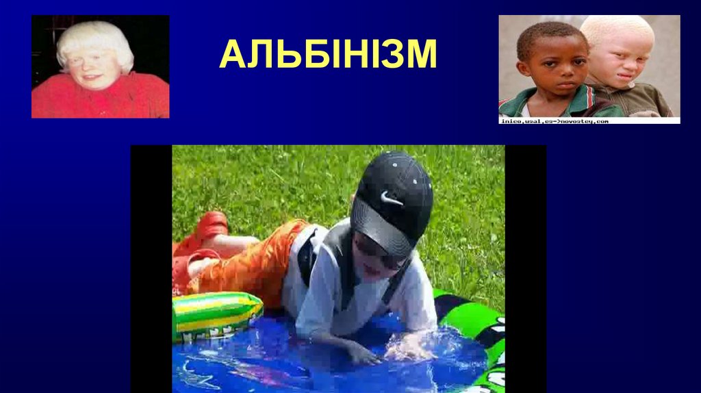 АЛЬБІНІЗМ
