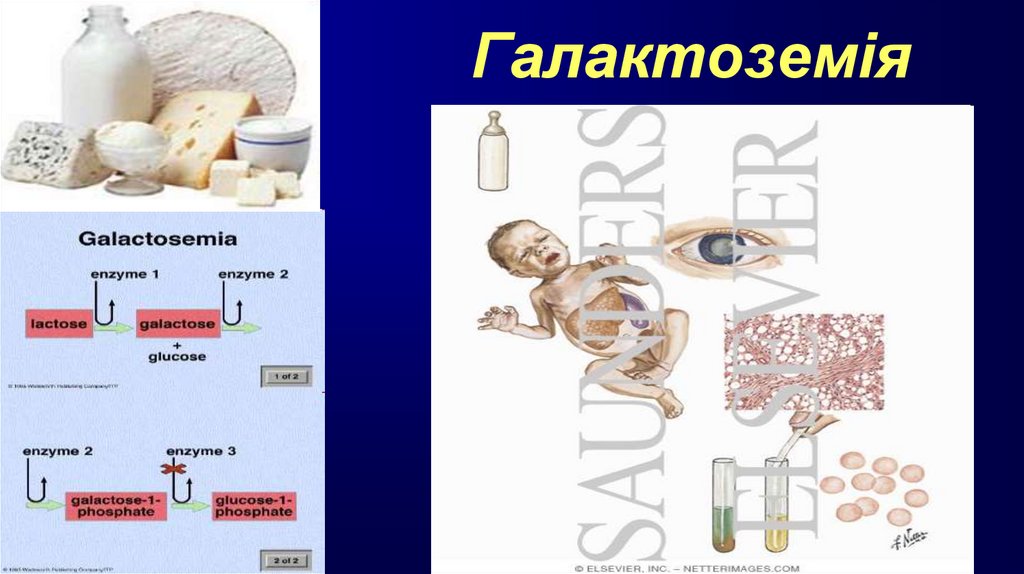 Галактоземія