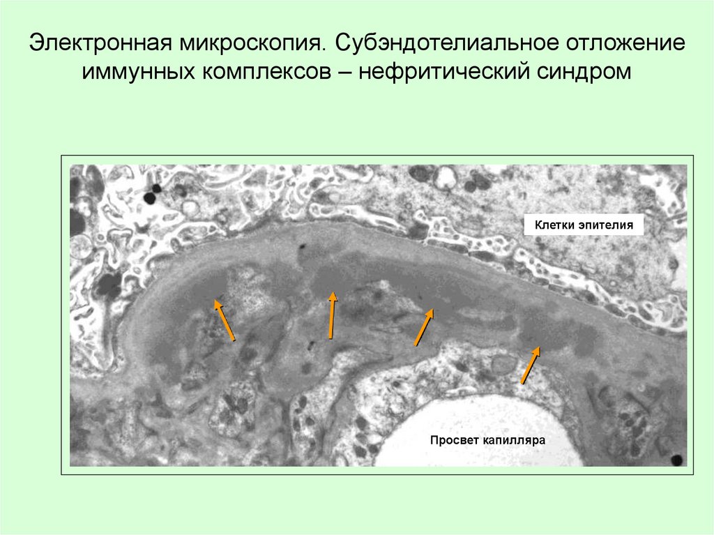 Электронная микроскопия. Субэндотелиальное отложение иммунных комплексов – нефритический синдром
