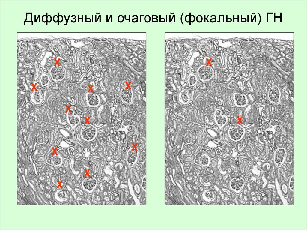 Диффузный и очаговый (фокальный) ГН