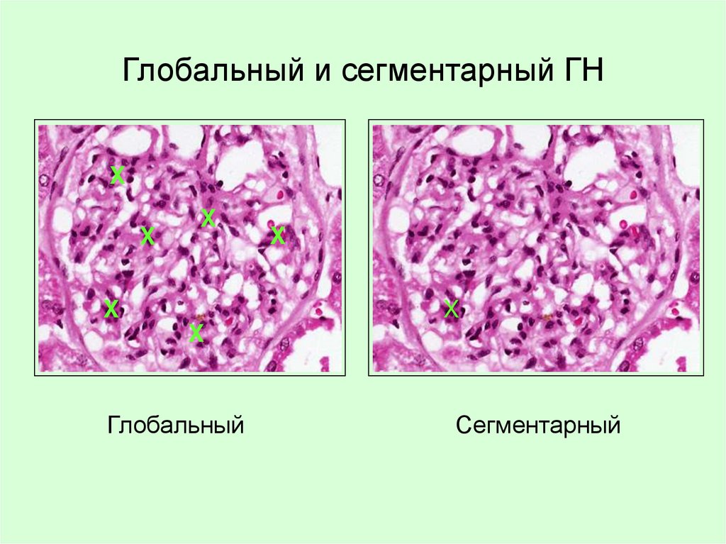 Глобальный и сегментарный ГН
