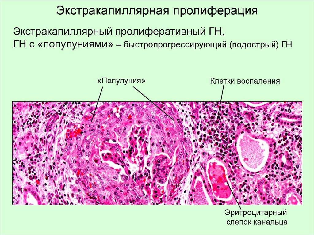 Экстракапиллярная пролиферация