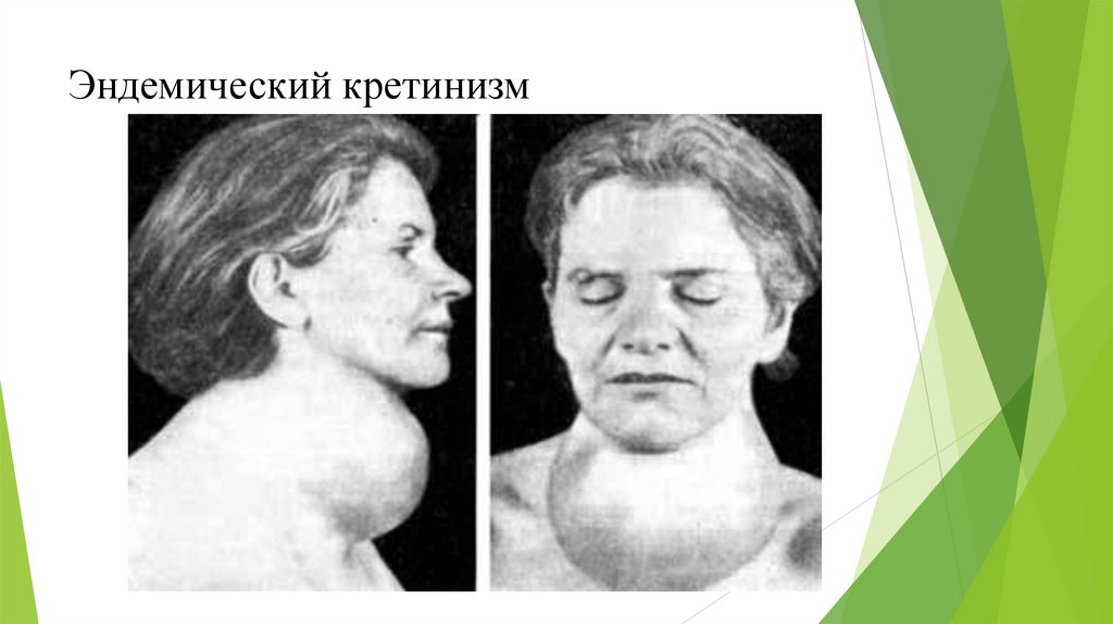 Эндемический кретинизм