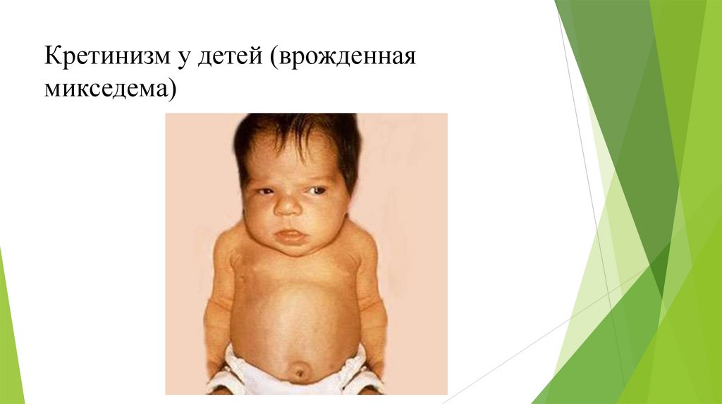 Кретинизм у детей (врожденная микседема)