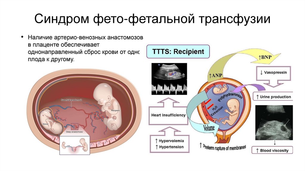 Синдром фето-фетальной трансфузии