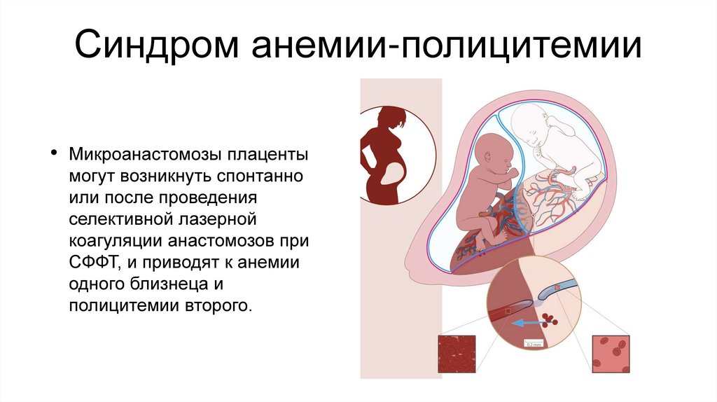 Синдром анемии-полицитемии