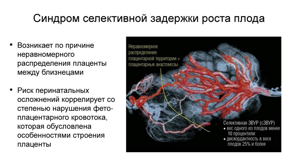 Синдром селективной задержки роста плода