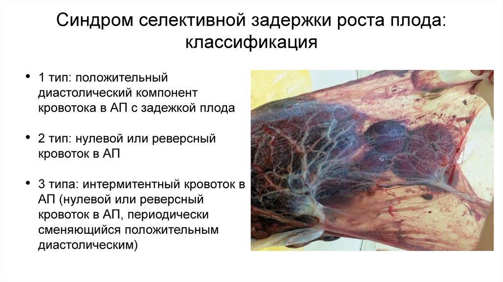 Синдром селективной задержки роста плода: классификация