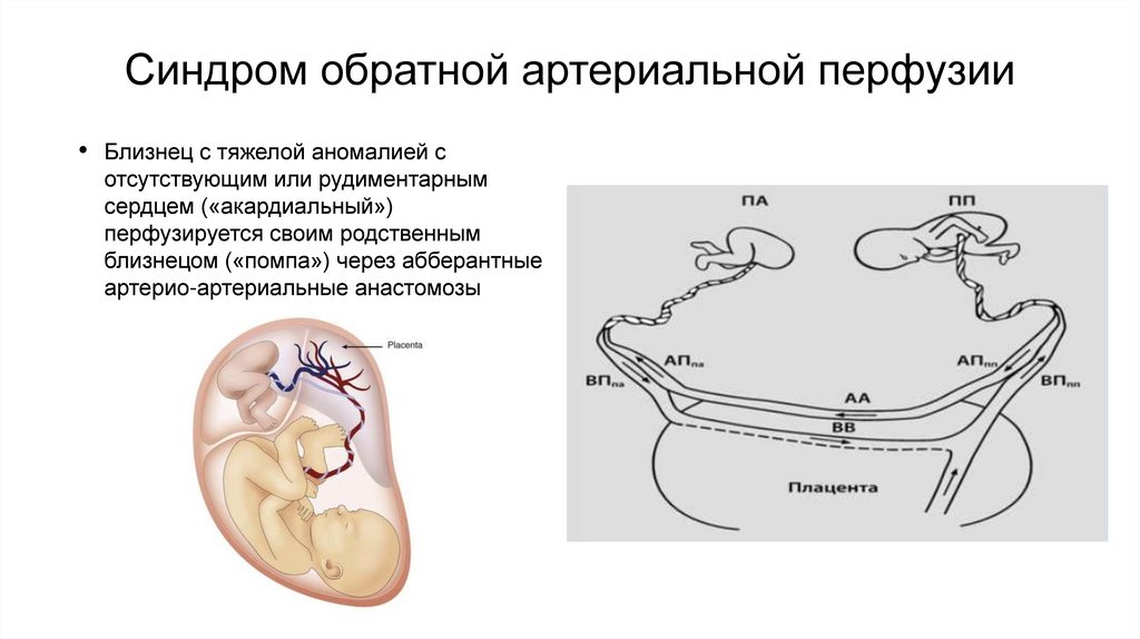 Синдром обратной артериальной перфузии
