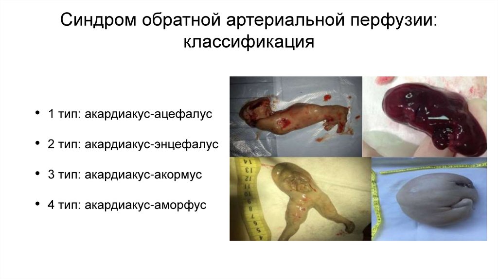 Синдром обратной артериальной перфузии: классификация