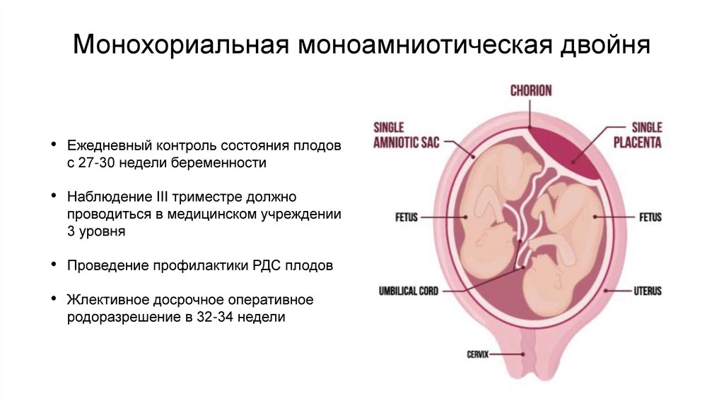 Монохориальная моноамниотическая двойня