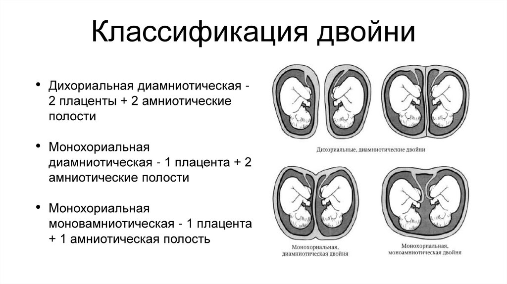 Классификация двойни