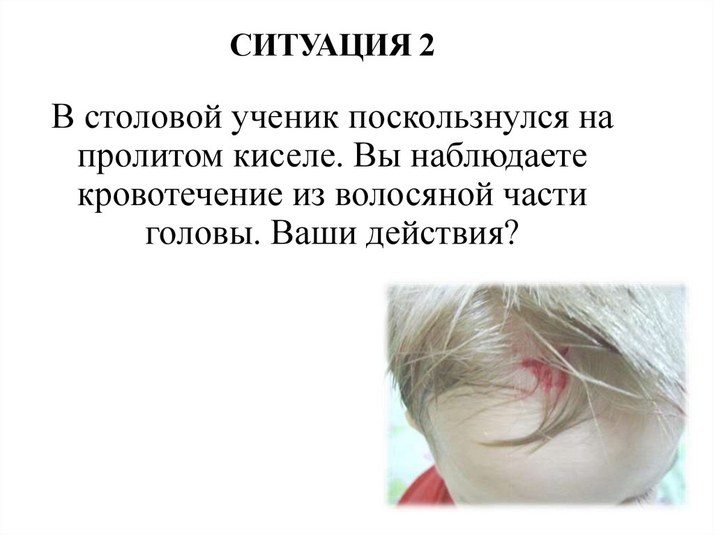 СИТУАЦИЯ 2 В столовой ученик поскользнулся на пролитом киселе. Вы наблюдаете кровотечение из волосяной части головы. Ваши