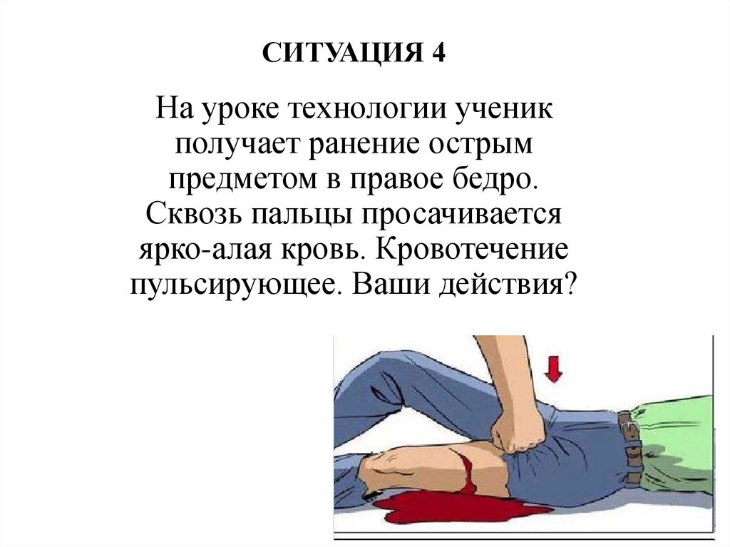 СИТУАЦИЯ 4 На уроке технологии ученик получает ранение острым предметом в правое бедро. Сквозь пальцы просачивается ярко-алая