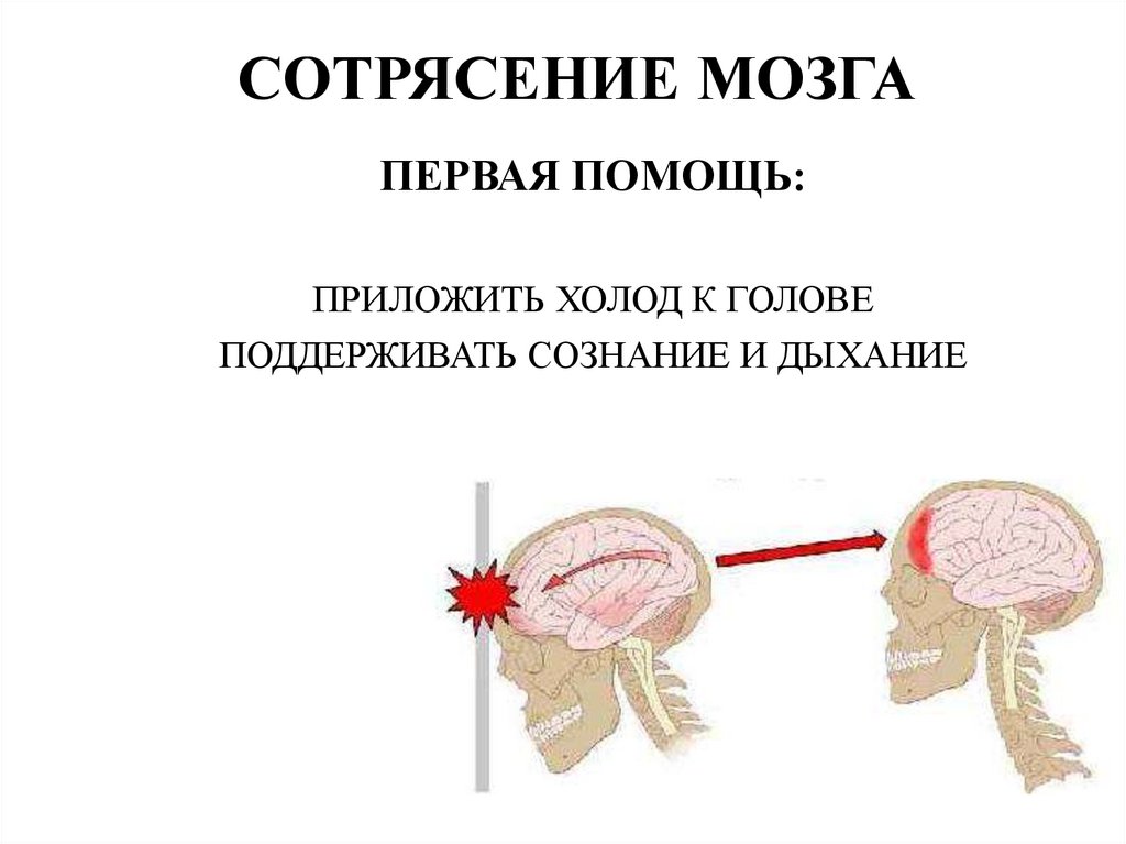 СОТРЯСЕНИЕ МОЗГА