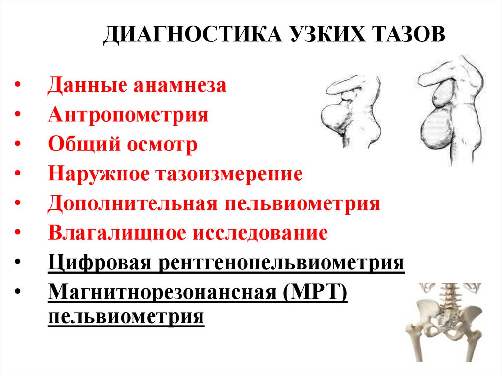ДИАГНОСТИКА УЗКИХ ТАЗОВ