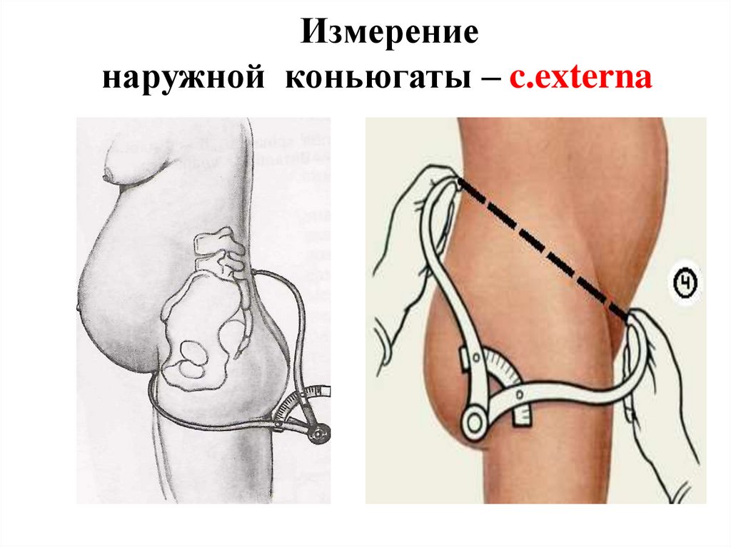 Измерение наружной коньюгаты – c.externa