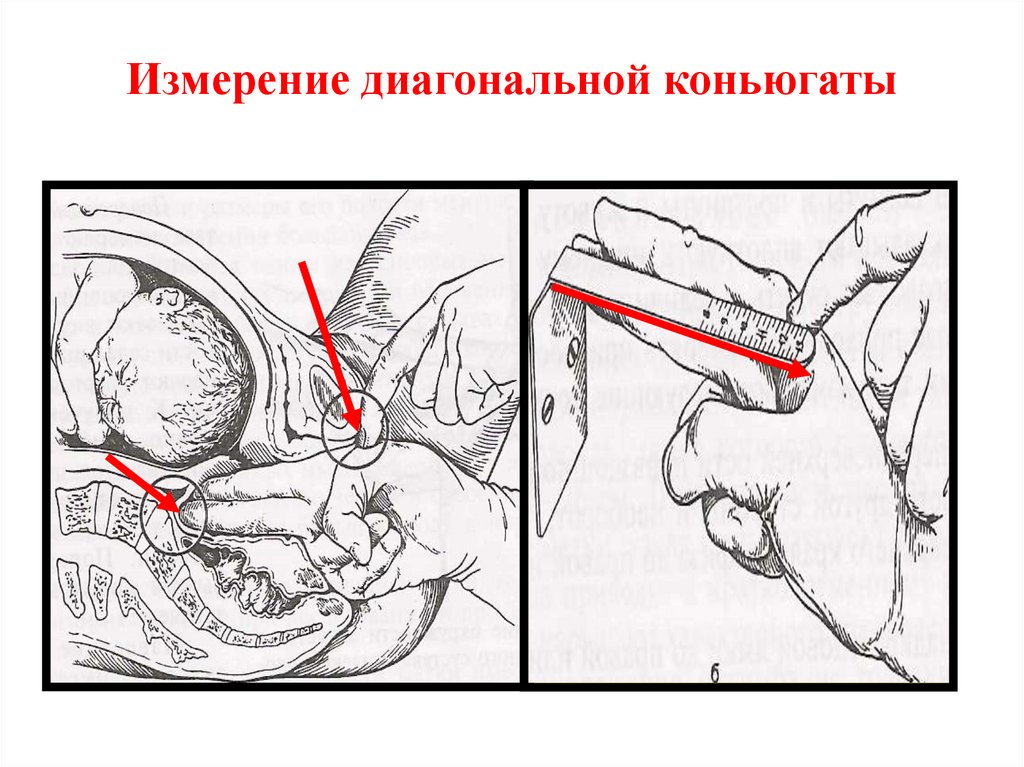 Измерение диагональной коньюгаты