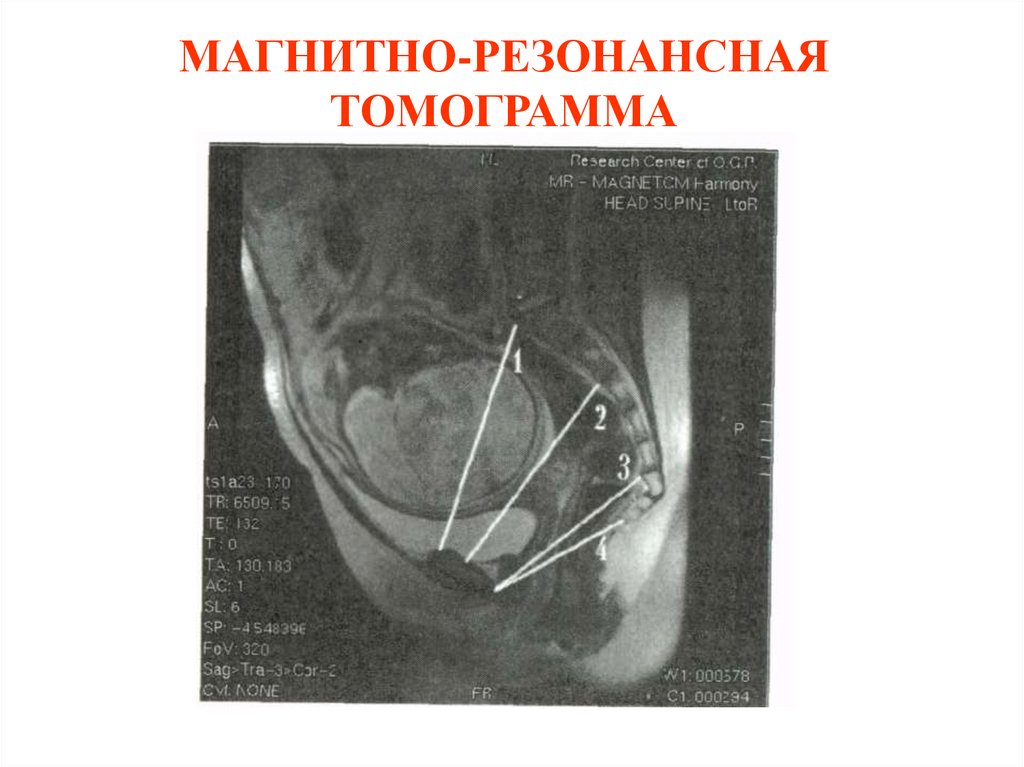 МАГНИТНО-РЕЗОНАНСНАЯ ТОМОГРАММА