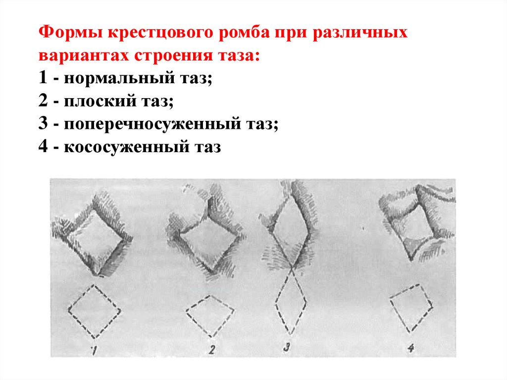 Формы крестцового ромба при различных вариантах строения таза: 1 - нормальный таз; 2 - плоский таз; 3 - поперечносуженный таз;