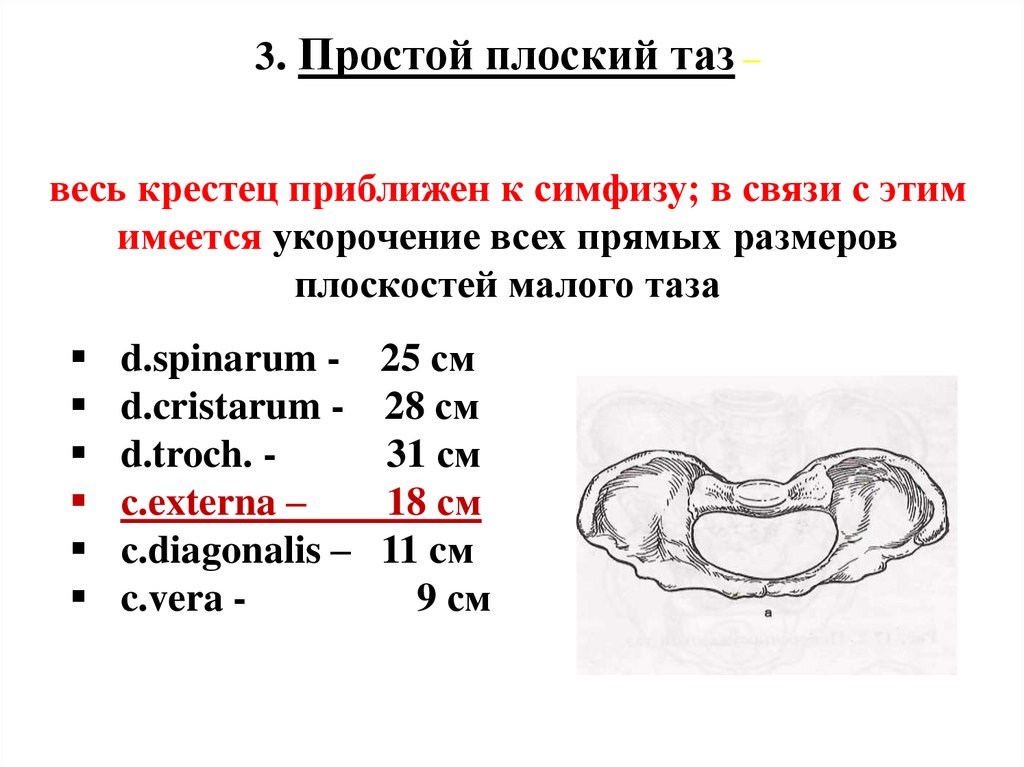 3. Простой плоский таз – весь крестец приближен к симфизу; в связи с этим имеется укорочение всех прямых размеров плоскостей