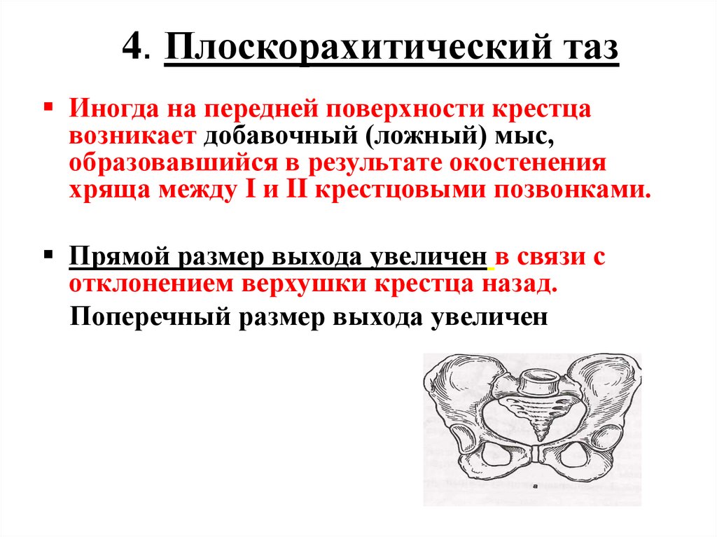 4. Плоскорахитический таз