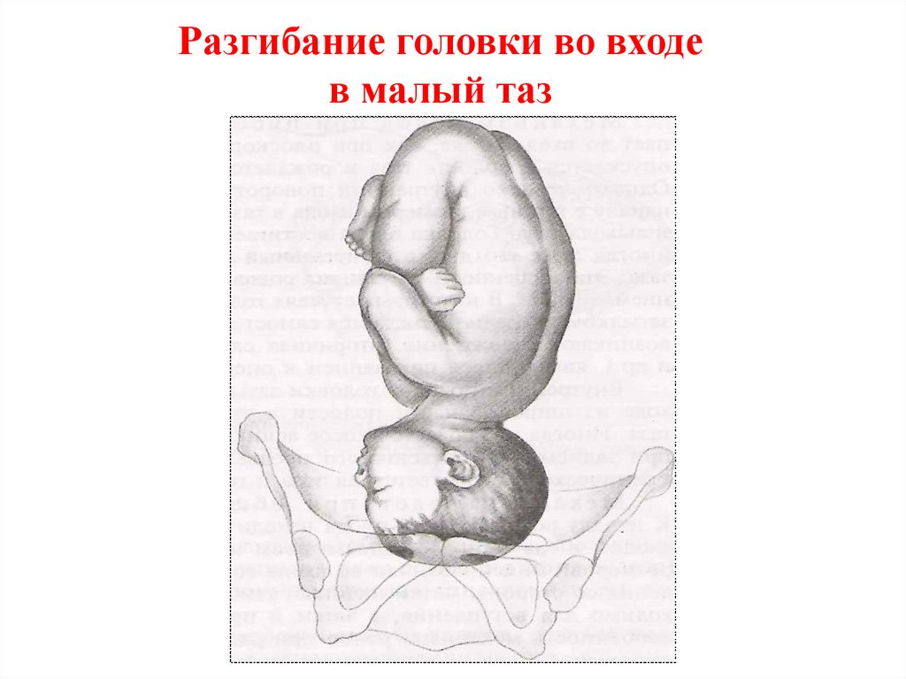 Разгибание головки во входе в малый таз