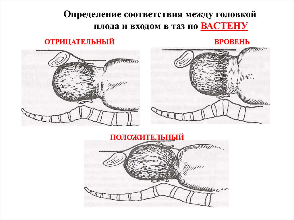 Определение соответствия между головкой плода и входом в таз по ВАСТЕНУ