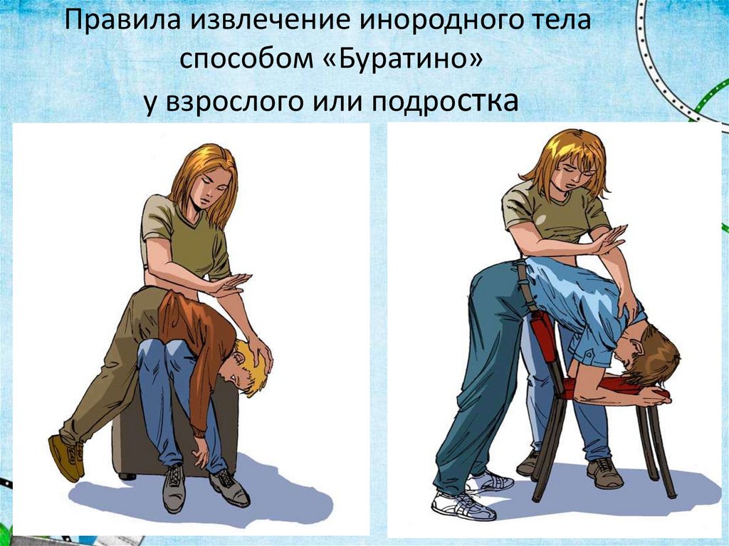 Правила извлечение инородного тела способом «Буратино» у взрослого или подростка