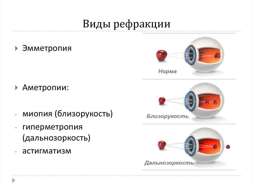 Виды рефракции