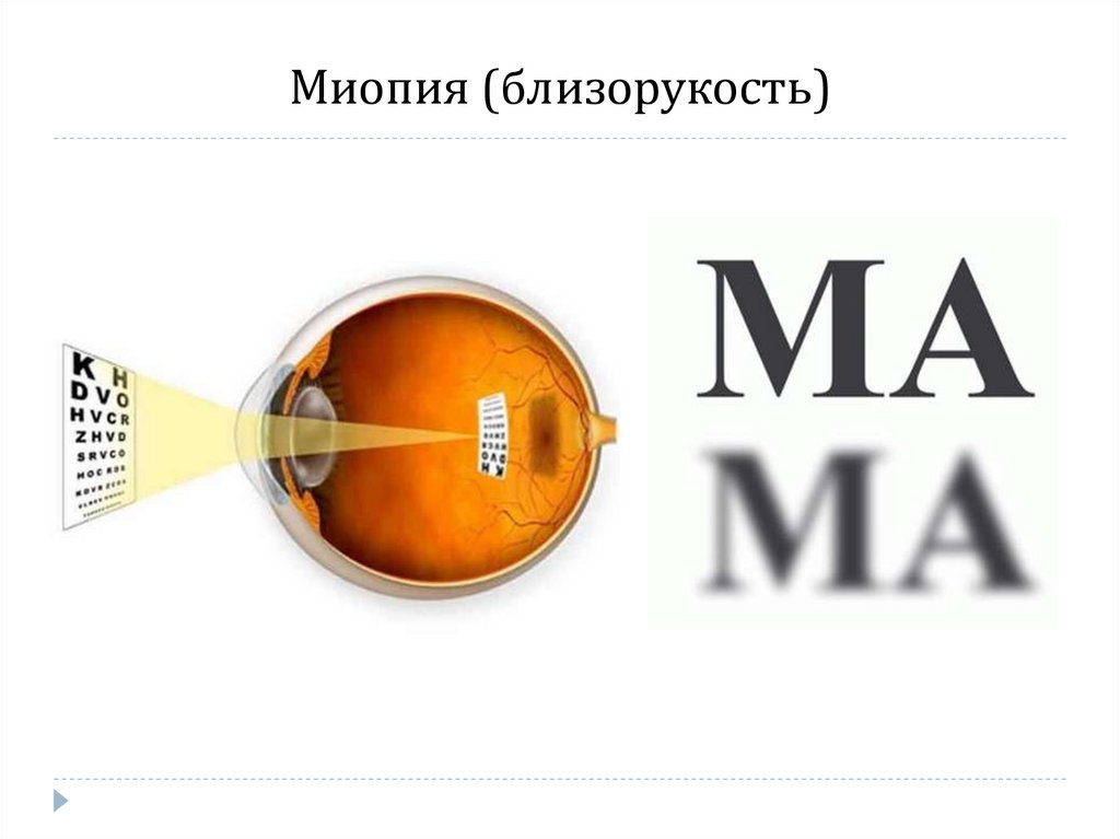 Миопия (близорукость)
