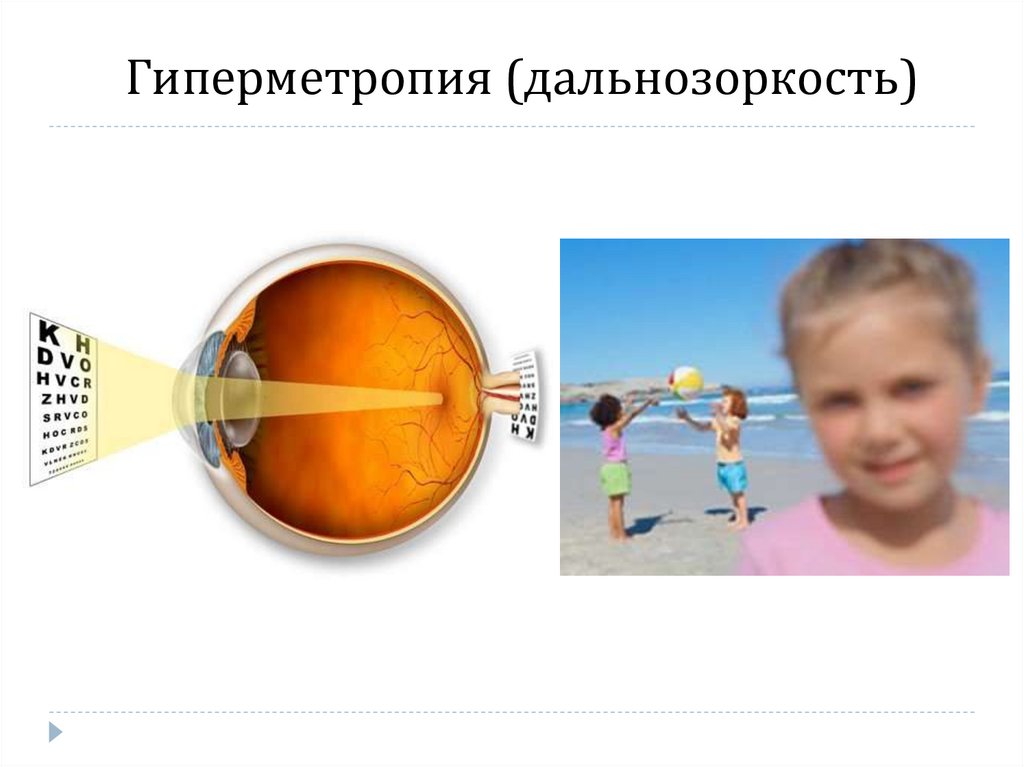 Гиперметропия (дальнозоркость)