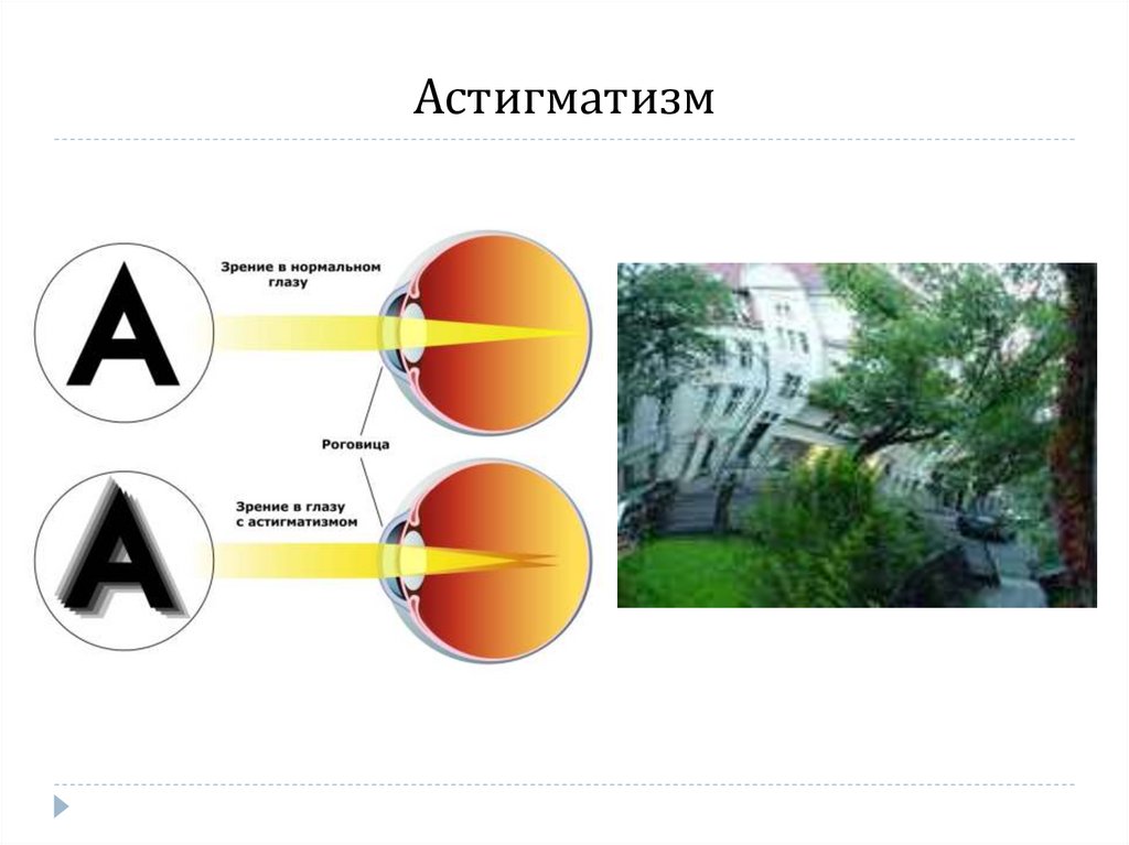 Астигматизм