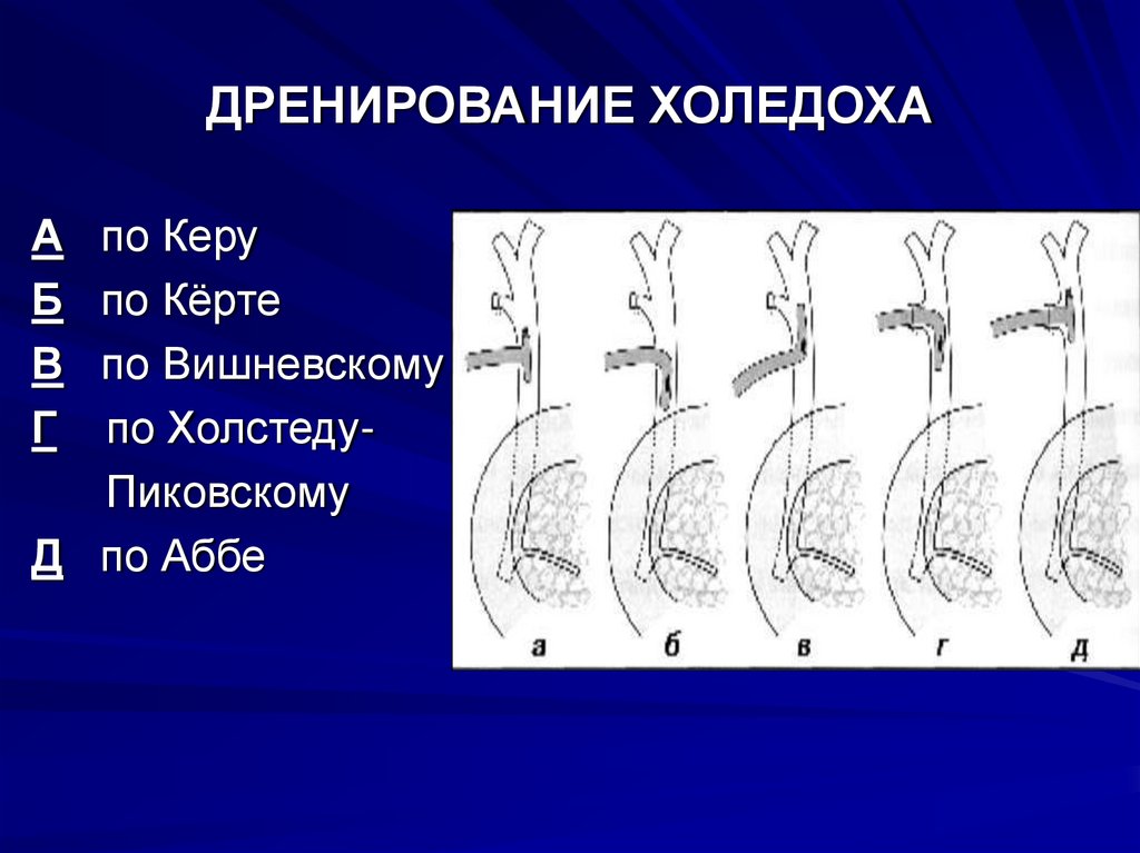 ДРЕНИРОВАНИЕ ХОЛЕДОХА