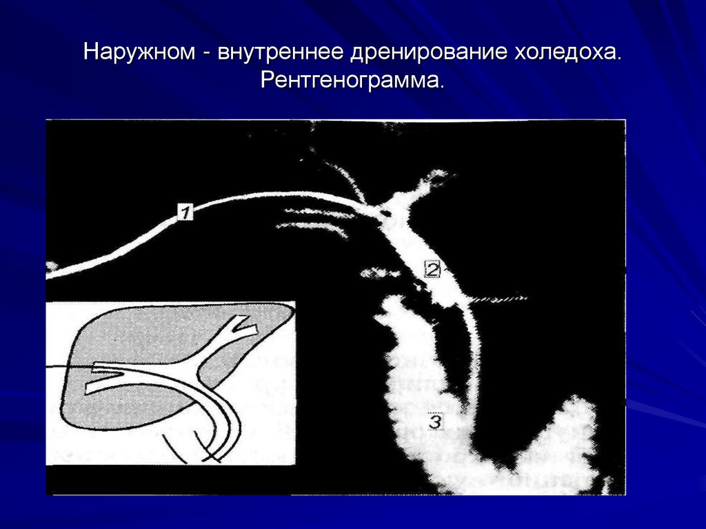 Наружном - внутреннее дренирование холедоха. Рентгенограмма.
