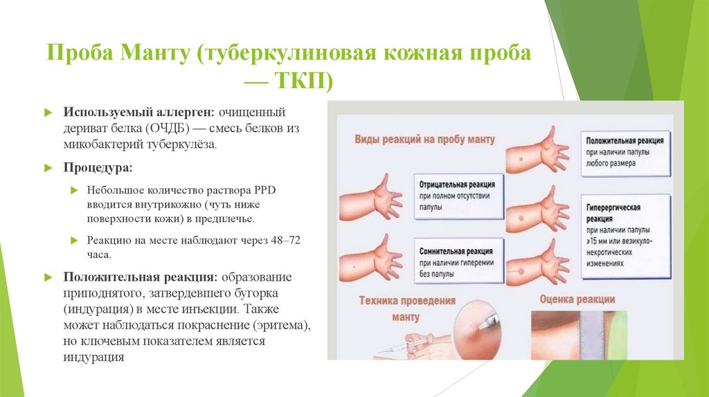 Проба Манту (туберкулиновая кожная проба — ТКП)