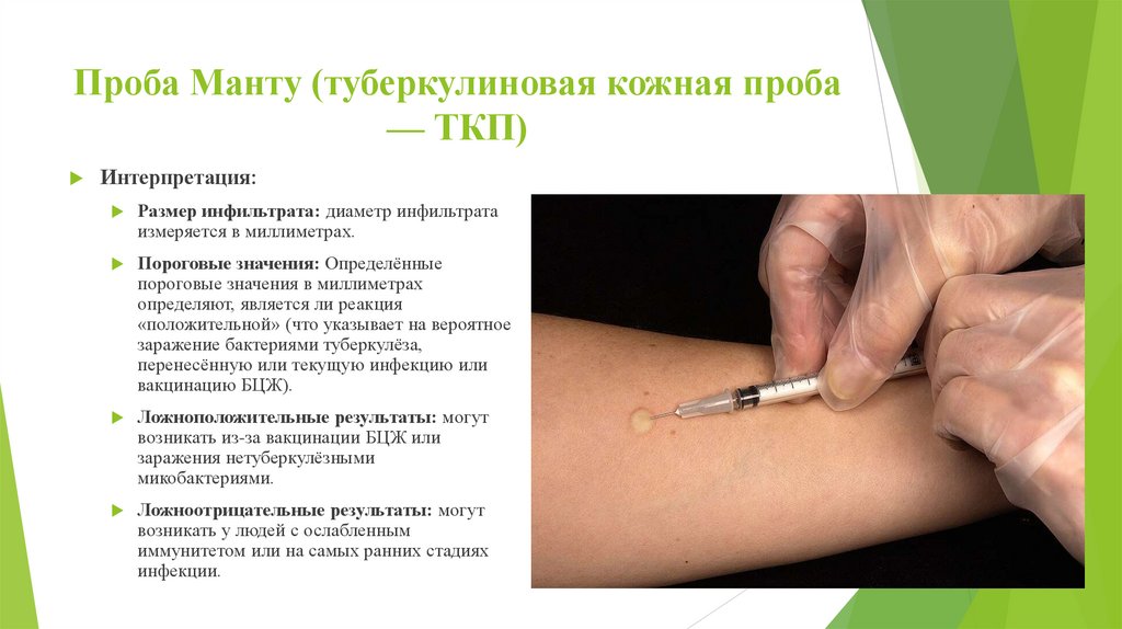 Проба Манту (туберкулиновая кожная проба — ТКП)