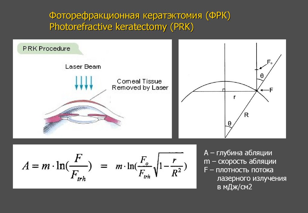 Фоторефракционная кератэктомия (ФРК) Photorefractive keratectomy (PRK)