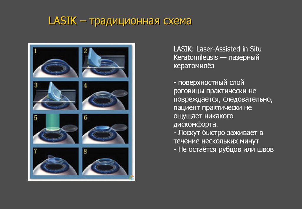 LASIK – традиционная схема