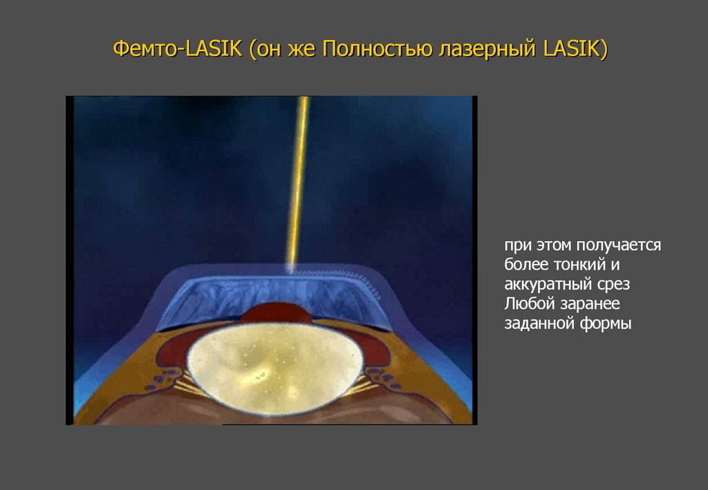 Фемто-LASIK (он же Полностью лазерный LASIK)