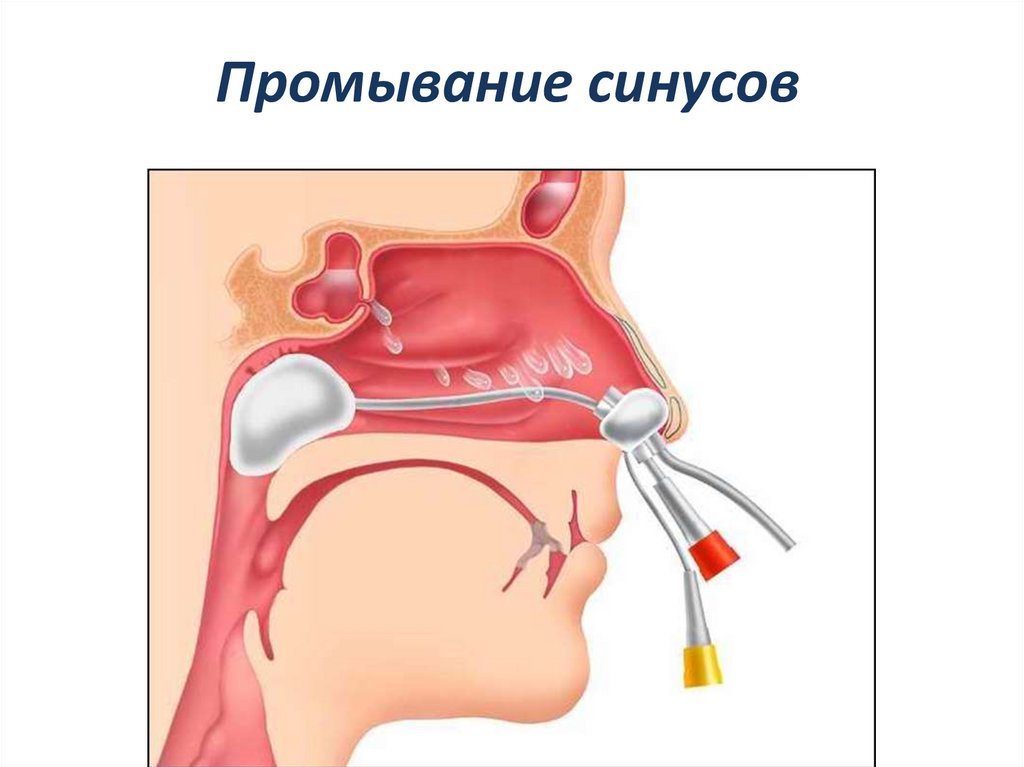 Промывание синусов